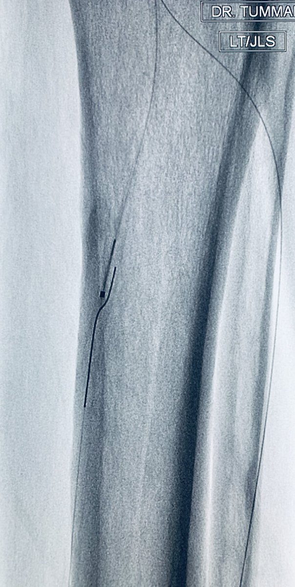 t_intheleadcoat's tweet photo. As a #CLIfigter, there will be clinical successes and failures...failures are equally if not more important than successes to learn and adapt. Time will be a judge of this one👇🏾
Heel ulcer, long PT #CTO, failed antegrade, #pedalloop conduit to cross.@SIRRFS #MedTwitter @CAIRweb https://t.co/SgLswR2yTU