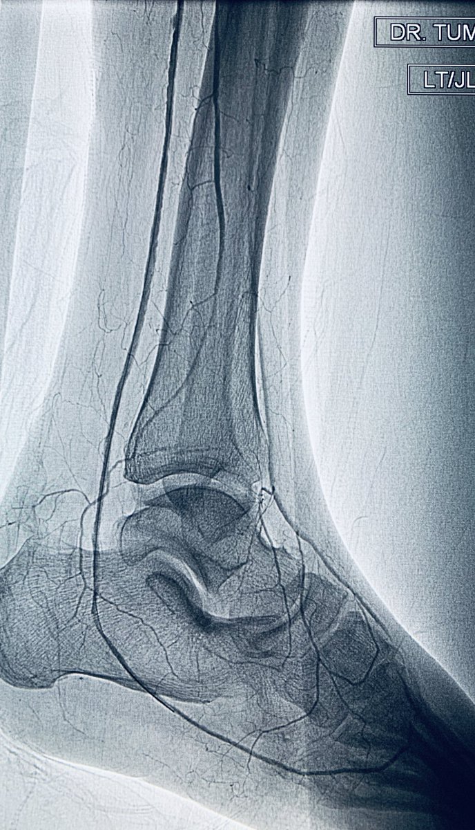 t_intheleadcoat's tweet photo. As a #CLIfigter, there will be clinical successes and failures...failures are equally if not more important than successes to learn and adapt. Time will be a judge of this one👇🏾
Heel ulcer, long PT #CTO, failed antegrade, #pedalloop conduit to cross.@SIRRFS #MedTwitter @CAIRweb https://t.co/SgLswR2yTU