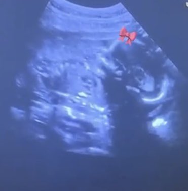 NiinaaaD's tweet photo. The ultrasound , The bump , The new born &amp; The present 🤰🏽👨‍👩‍👧💜 https://t.co/VpyxmU4ig2