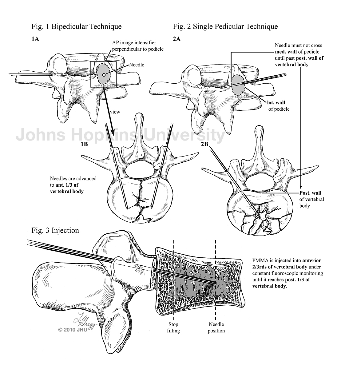 LydiaJGregg's tweet photo. #ThrowbackThursday: vertebroplasty, bipedicular vs. single pedicular approach. In the 2010 edition of the Handbook of Interventional Radiologic Procedures by Kandarpa and Lindsay https://t.co/uhq726w3Sl