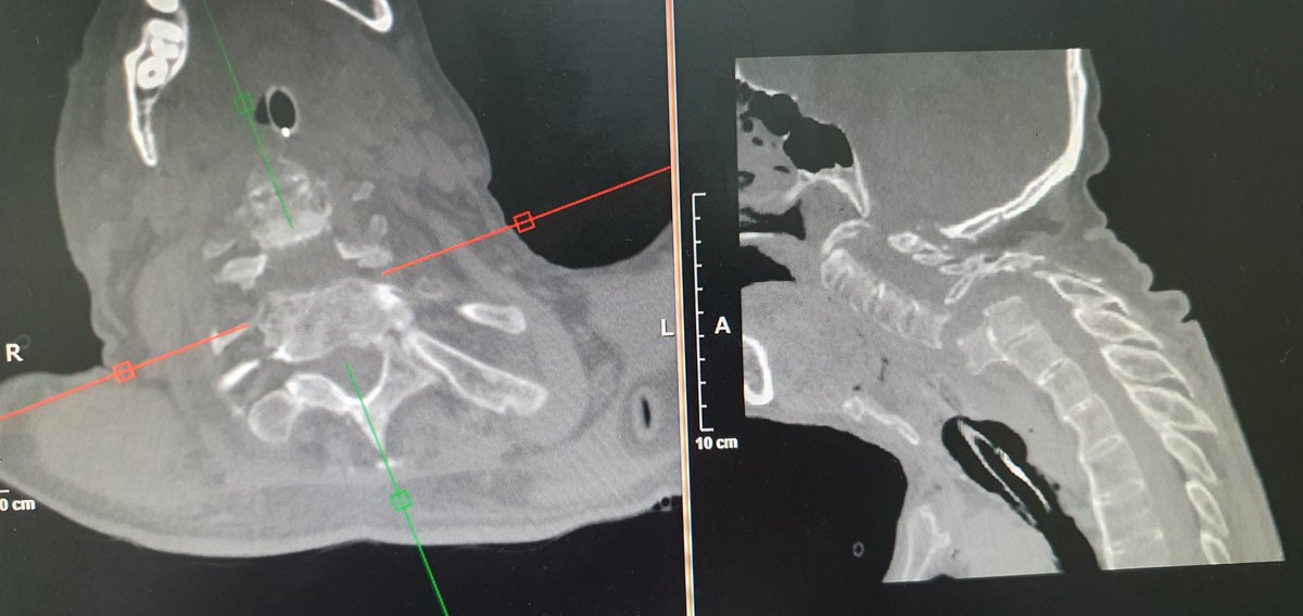 altamijackson's tweet photo. *Llega paciente a choque*
- ¿Qué le pasó?
- Lo llevaron a sobar
El ajuste vertebral del quiropráctico: https://t.co/rKJUtiCc90