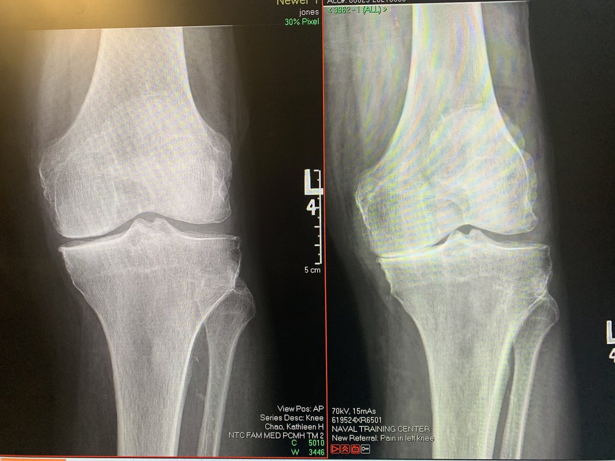 Your monthly reminder to get weightbearing xrays for all patients with presumed knee/hip arthritis. 
Same patient. 8 days apart. 
Left is non-weightbearing, right is weightbearing. 
Left gets PT and NSAIDs, right is picking a date for arthroplasty.
