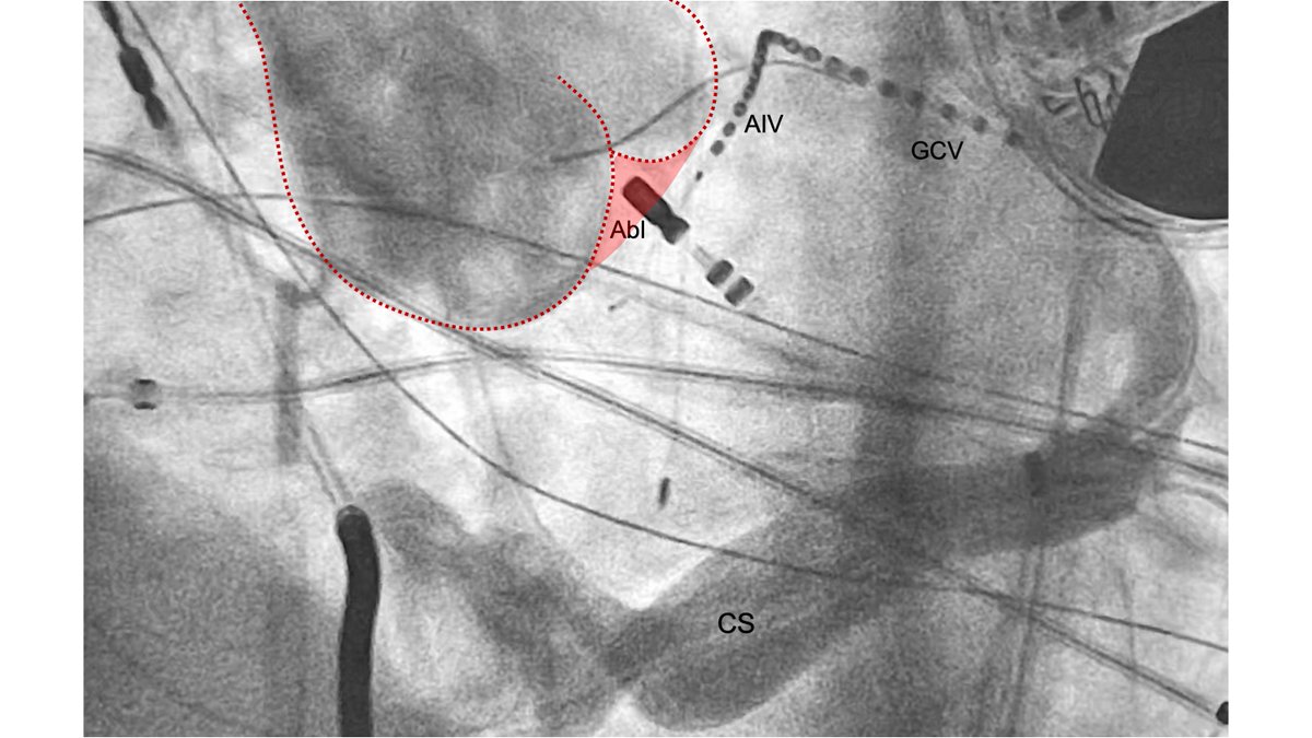 DrRoderickTung's tweet photo. @MRobinsonEP Interleaflet triangle is just specific anatomical term for below/in-between the valve cusps. We have found R-L ILT is nice vantage point for the septal margin of LV summit.  The view out from this triangular window is the epimyocardium directly underneath the LAD. https://t.co/Jcbtev3XGK