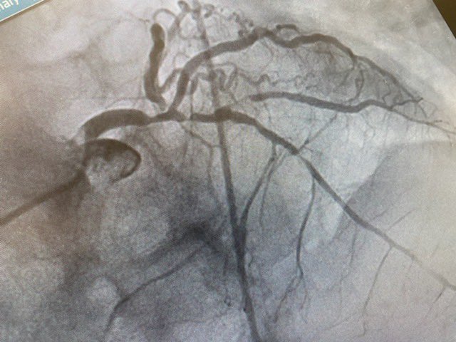 CheemaFACC's tweet image. Ostial LCX is 99%, LM, LAD, Diag as you see. How do you tackle ⁦@ShariqShamimMD⁩ ⁦@Asaadakbarkhan⁩