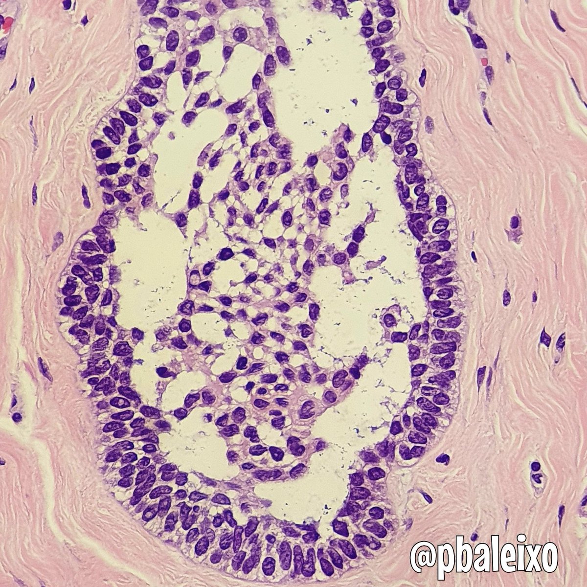 pbaleixo's tweet photo. Ameloblastoma 》>>mandible》locally aggressive》rarely malignant》peripheral columnar cells with reverse polarized palisaded nuclei + stellate reticulum》classic variant follicular #pathology #oralpath @smlungpathguy @JMGardnerMD @UFCSPA_patho @luishcruzc @KMirza @ALBoothMD https://t.co/7ghocIPi3s