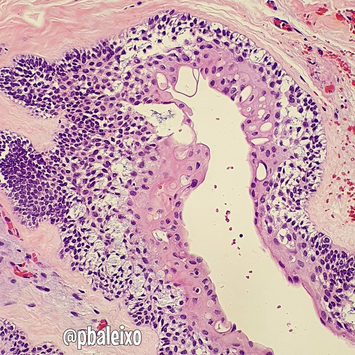 pbaleixo's tweet photo. Ameloblastoma 》>>mandible》locally aggressive》rarely malignant》peripheral columnar cells with reverse polarized palisaded nuclei + stellate reticulum》classic variant follicular #pathology #oralpath @smlungpathguy @JMGardnerMD @UFCSPA_patho @luishcruzc @KMirza @ALBoothMD https://t.co/7ghocIPi3s