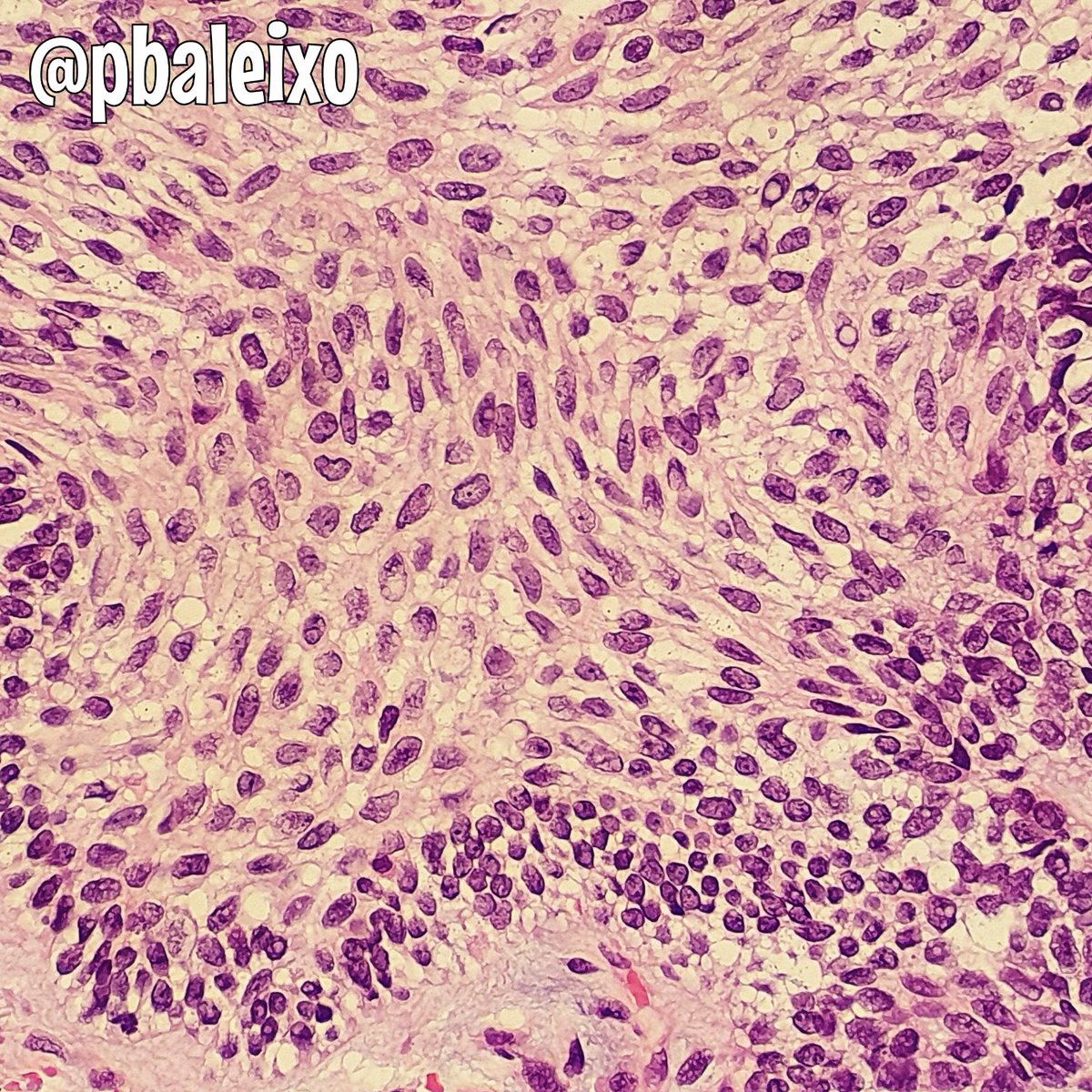 pbaleixo's tweet photo. Ameloblastoma 》>>mandible》locally aggressive》rarely malignant》peripheral columnar cells with reverse polarized palisaded nuclei + stellate reticulum》classic variant follicular #pathology #oralpath @smlungpathguy @JMGardnerMD @UFCSPA_patho @luishcruzc @KMirza @ALBoothMD https://t.co/7ghocIPi3s