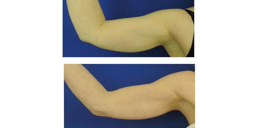 SplitRockAesIns's tweet photo. Our photos say it all!! Lift, firm, and lose arm fat with Exilis Ultra 360!
•
Nonsurgical full-body solution for fat burning, tissue lifting &amp; skin tightening to help you achieve your aesthetic goals with virtually no discomfort or downtime. https://t.co/HxoDvAOFpG