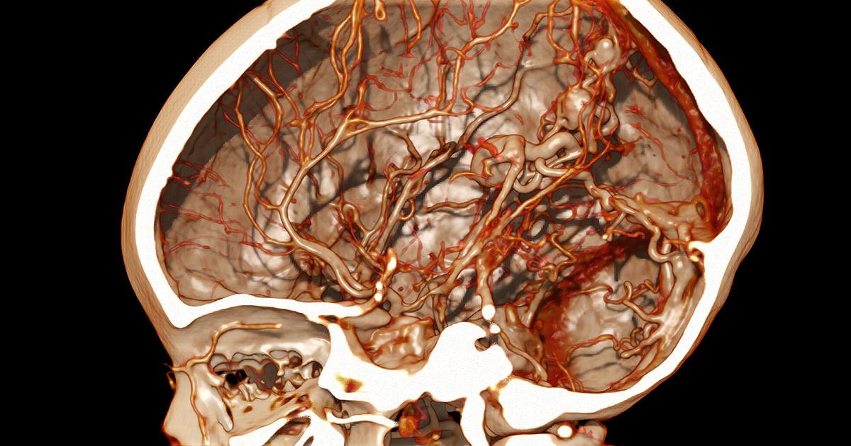 CanonMedical's tweet photo. See how clear this pediatric AVM and cerebral aneurysm is with #GlobalIllumination? It’s images like this that will help you improve the way you treat and manage your patients in the future. #TheNewStandard #AdvancedVisualisation 

Visit https://t.co/tVPMsCQAtC for more. https://t.co/vxekJeFgSi