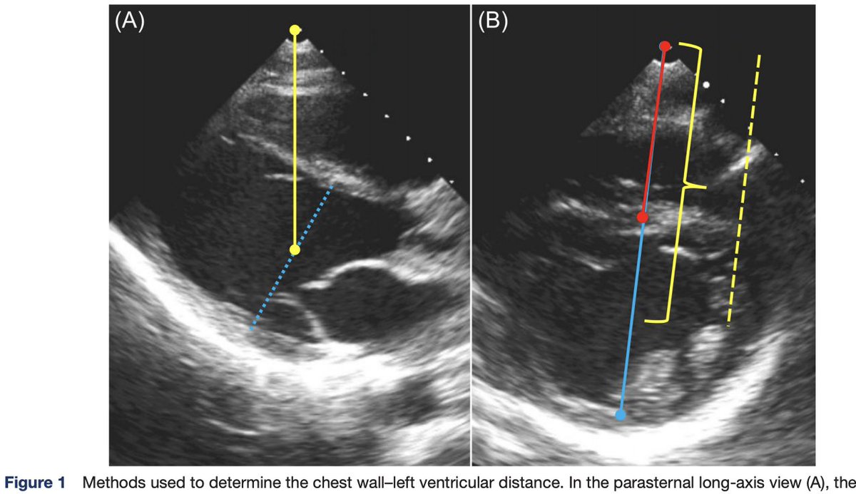 Impact of the distance from the chest wall to the heart on surface ECG voltage in athletes 

Interesting Study by <a href="/StanfordCVI/">Stanford CVI</a> <a href="/KristoferHedman/">Kristofer Hedman</a> <a href="/alepattimd/">Alessandro Patti</a> <a href="/KegJM/">Kegan Moneghetti</a> <a href="/jwc14/">Jeff W Christle</a> <a href="/euanashley/">euan ashley</a> 

ow.ly/JpIF50B6DQM