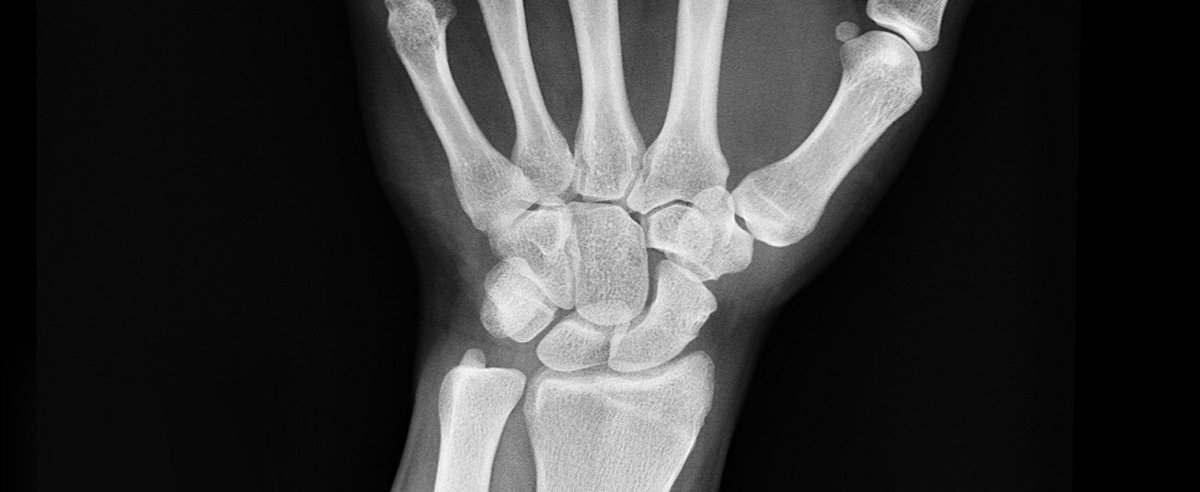 Opportunity_NE1's tweet photo. Industry, academics &amp; clinicians are collaborating in Aberdeen to apply artificial intelligence to fracture diagnosis in hospitals in a landmark digital project co-funded by ONE &amp; @scotgov #ONELifeSciences #lifesciences #AI #digitalhealth https://t.co/JKRGzGG06a https://t.co/SVt93KcWib