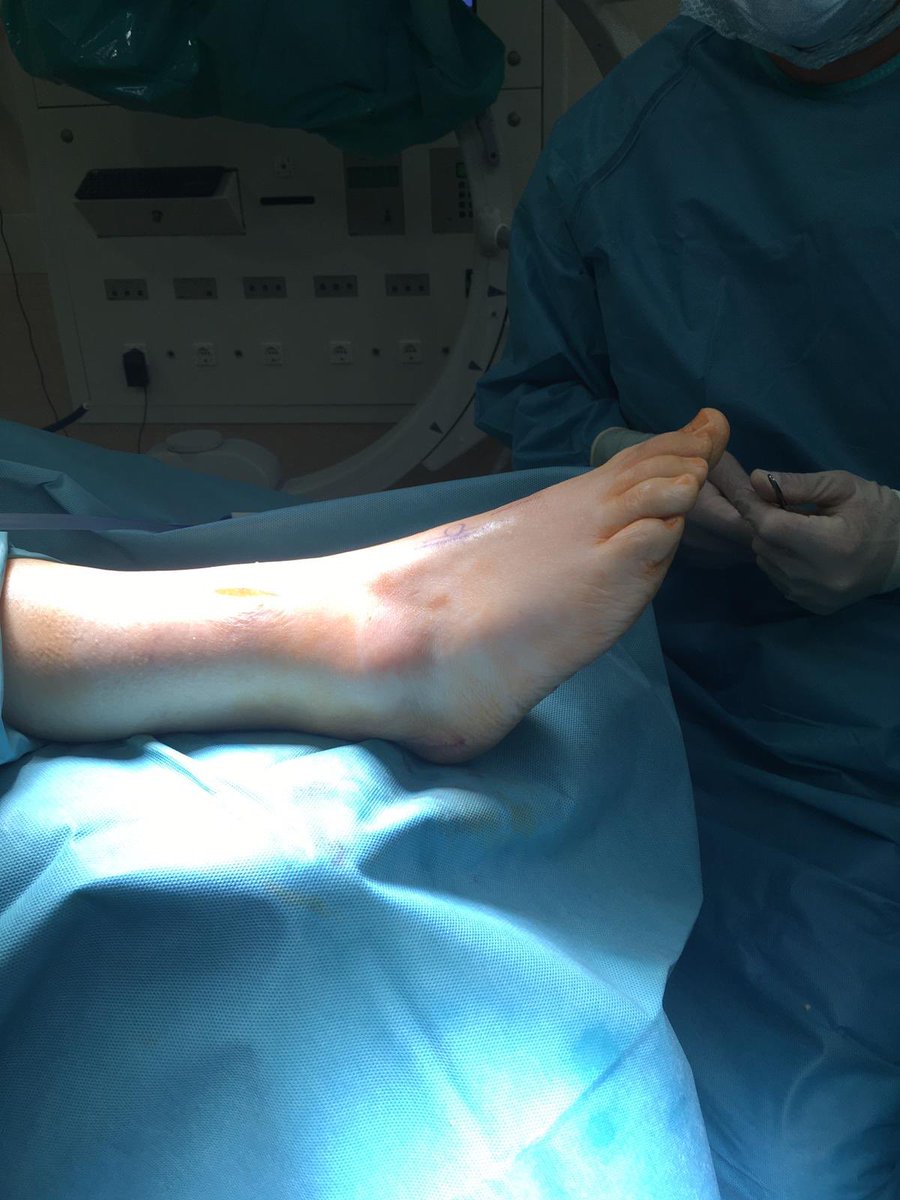 DrRamonNavarro's tweet image. 📷Caso clínico. Manejo del pie caído, #footdrop con afectación intensa de la marcha.                      Transferencia del tendón tibial posterior mediante técnica 4 incisiones.