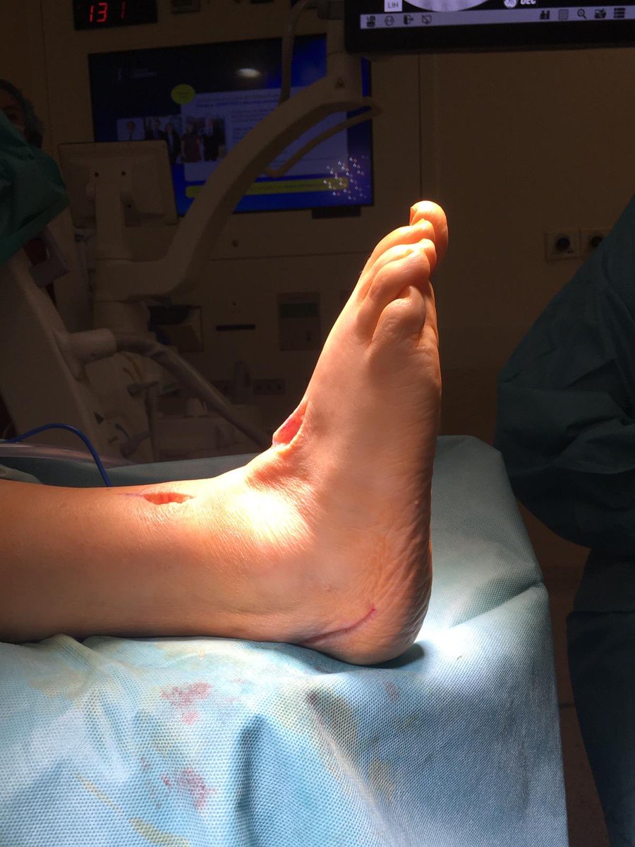 DrRamonNavarro's tweet image. 📷Caso clínico. Manejo del pie caído, #footdrop con afectación intensa de la marcha.                      Transferencia del tendón tibial posterior mediante técnica 4 incisiones.