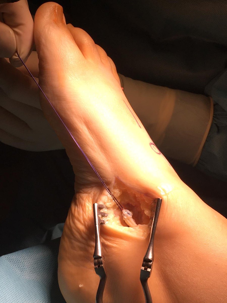 DrRamonNavarro's tweet image. 📷Caso clínico. Manejo del pie caído, #footdrop con afectación intensa de la marcha.                      Transferencia del tendón tibial posterior mediante técnica 4 incisiones.