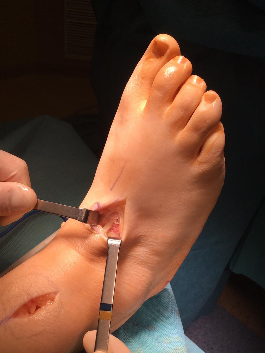 DrRamonNavarro's tweet image. 📷Manejo del pie caído. #footdrop                   @ClinicaCEMTRO Transferencia del tendón tibial posterior mediante técnica 4 incisiones.                                               Pasos importantes
🔸Fijación con tornillo interferencial en 2a cuña en flexión dorsal