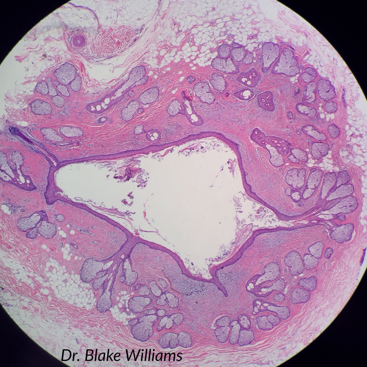 JMGardnerMD's tweet photo. Folliculosebaceous cystic hamartoma. Sebaceous glands & follicles empty into dilated cyst. Dense surrounding stroma. More info in my #dermpath #pathsurvivalguide: https://t.co/85dyJi37nn #pathology #dermatology https://t.co/MqsogEQpJc