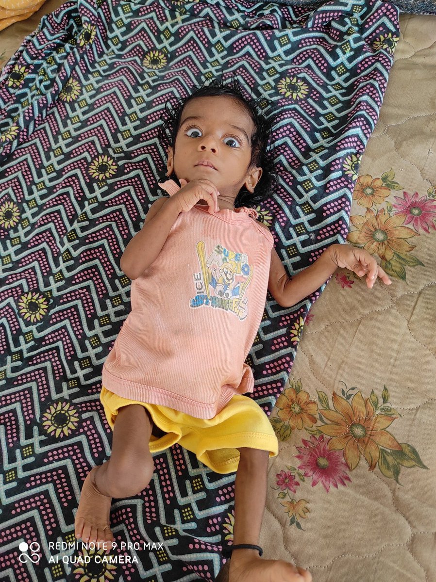Durgaprasad5363's tweet photo. @SonuSood
Hello sir, 
Kindly spare a minute for reading this. Satwik is a lovely seven month old boy.  He was diagnosed with congenital heart disease- VSD (hole in the heart). He suffers from severe weight loss and has recurrent respiratory infection. Contact details:9966752148 https://t.co/RWs7rZN8zv
