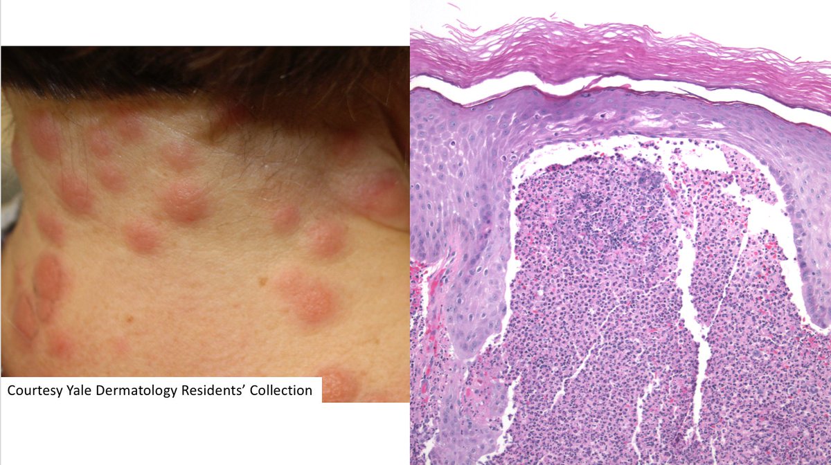 ChristineJKoMD's tweet photo. Classic dermatology juicy red papulonodules - what's your diagnosis? Short #clinpathcorrelation video answer at https://t.co/92aDdYemWT #cpKo #MedStudentTwitter https://t.co/MfLeJDfVNb