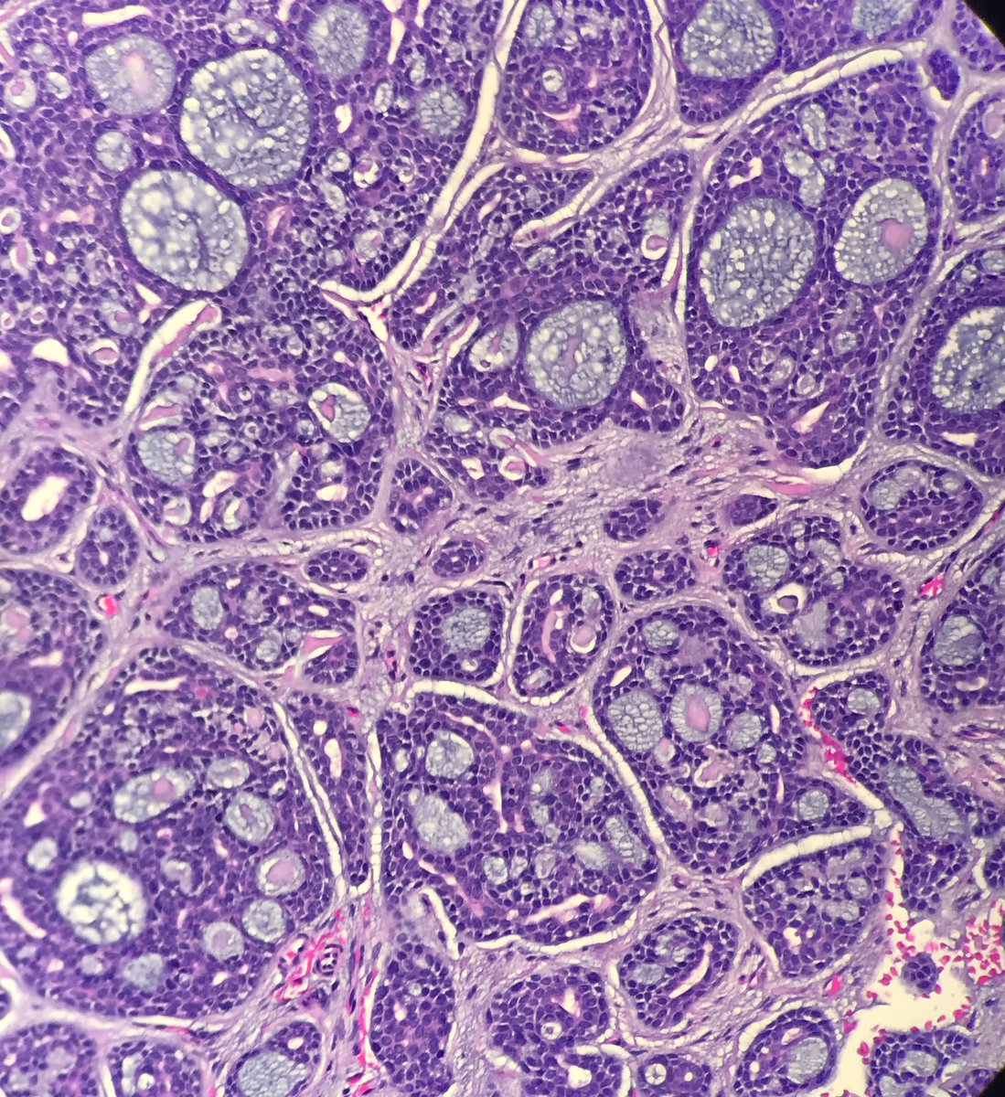 SimonRoyMD's tweet photo. Salivary gland tumor #entpath #boardspotter https://t.co/lxR3oz9KgB