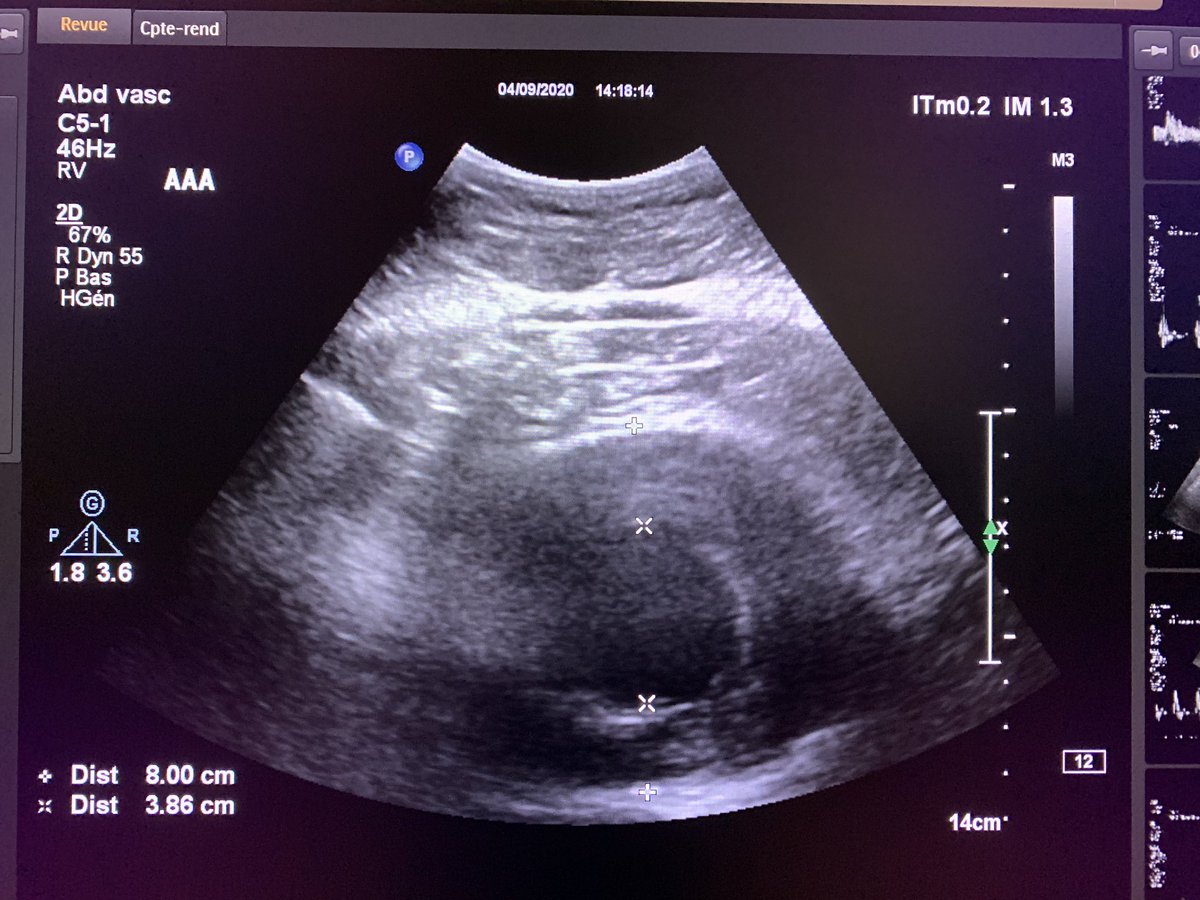 benjaminseffert's tweet photo. Oups...le moment où on se dit qu’il faut arrêter d’appuyer @lasfmv @Echoraljpangio @ChuSaintEtienne @afintmedvasc @MedvascC #AAA #anevrisme #aorte #aorticaneurysm https://t.co/93NZZJsc4f