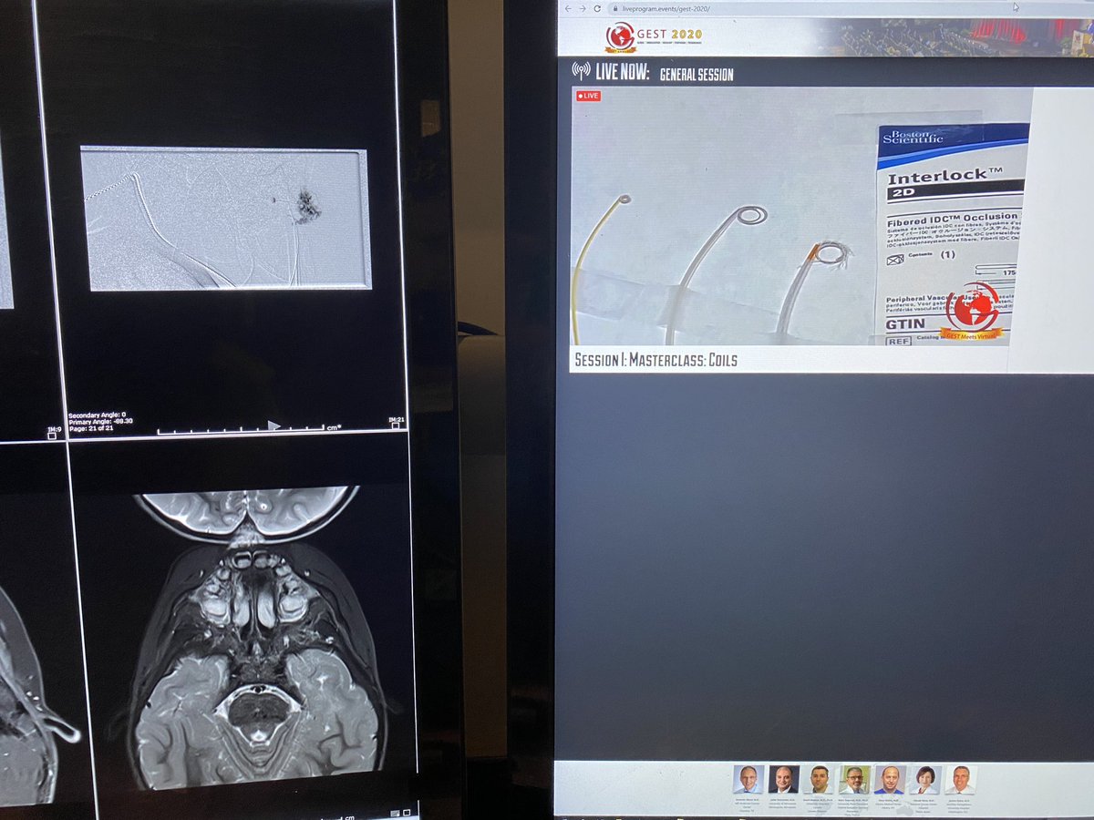 trevorlewis_md's tweet photo. #GEST2020 Could maybe get use to the virtual format.  Makes for a very efficient use of time in between cases. @SIRRFS @SIRspecialists @BIDMCVIR @HelenV_  🤓 https://t.co/fAL5n9mFCk