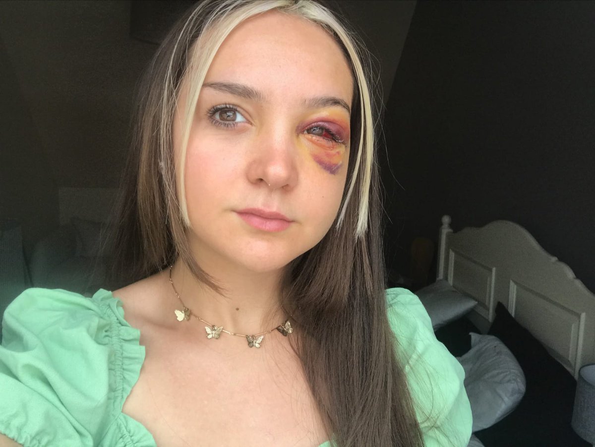 Mediavenir's tweet photo. 🇫🇷 Agression : Luane et Claire, 18 ans, se sont fait rouer de coups à #Strasbourg fin août par un garçon de 16 ans. Le motif ? Il voulait les forcer à donner leur numéro de #telephone... Une plainte a été déposée. L'adolescent est recherché par la #police. (C8 / DNA) #France https://t.co/tnIm0f9KP4