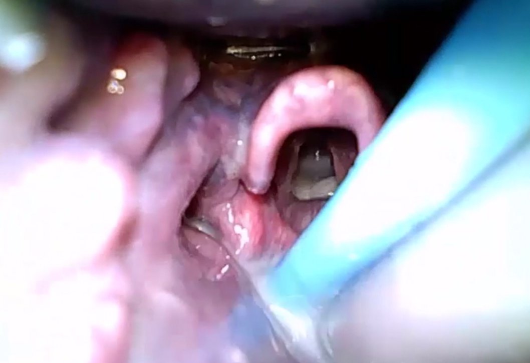 Arrest + CPR fluid filled airway, intubator got a view of cords using channeled VL, inserted bougie, tried railroading tube multiple times to no avail. On withdrawal you have this view, bougie nearby. They are 85s into attempt. What should be done? patreon.com/posts/41184171