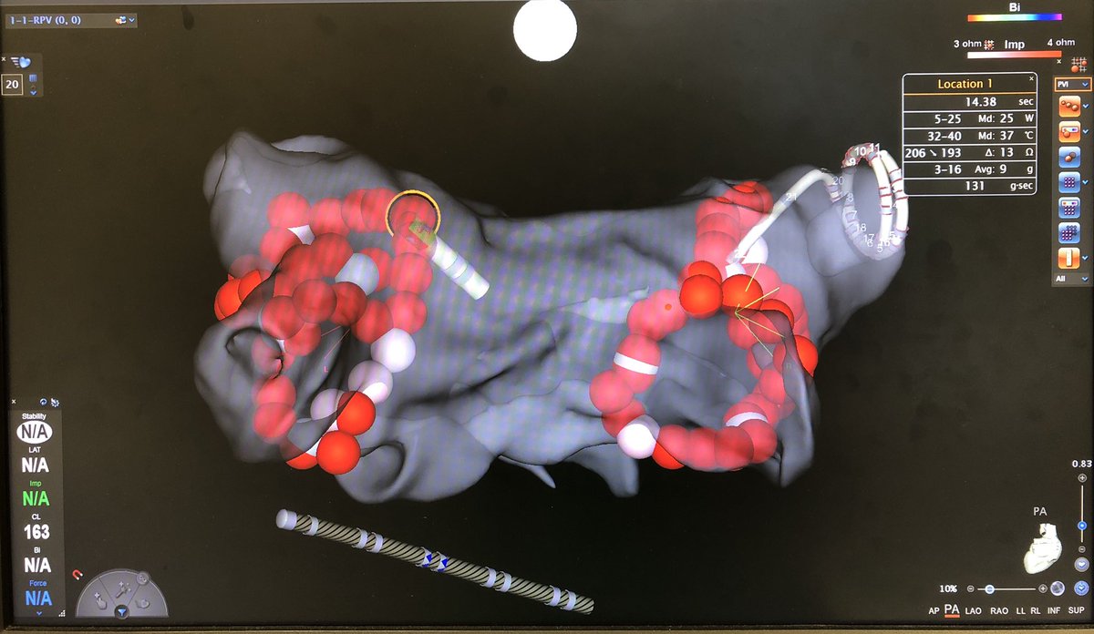  #EPeeps Are you looking for something to do while visitags turn red?Here’s an idea+it even involves looking at much beloved squiggly lines: transmural RF effect in vivo!Pic: LAPW 1st siteGA, Agilis, CS pacing 600ms, 5ml/kg IPPV2mm stability, CF 100% min 1g, ACCURESP off.