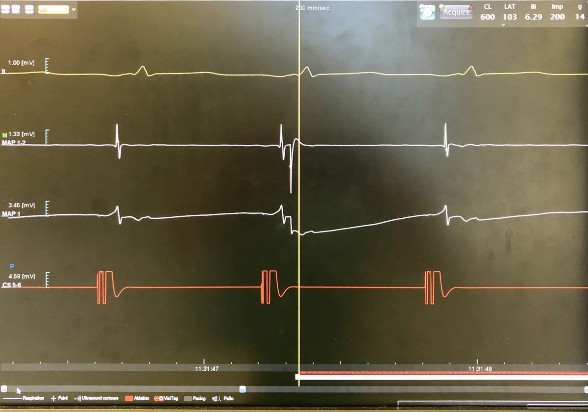 Pic: corresponding CARTOREPLAY EGMs at RF onset (see red line indicating annotation start at the bottom)Top to bottom:BS ECGMAP1-2 bipole 1.33 mV scaleMAP1 unipolar EGM 3.45mV scale clearly RS morphology CS pacingDon’t worry, it’s about to get exciting  #EPeeps 