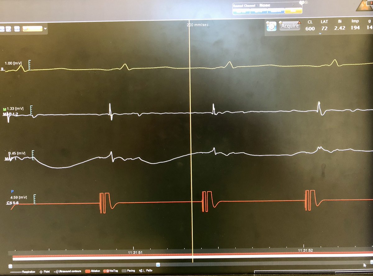 Just over 4s into this 25W application (remember, lower power at left-sided LAPW sites), final unipolar EGM morphology clearly changes to pure R.Ok, ~5% of cases have artifact making the exact timing of first transmural transition less clear, but honestly, it’s usually as shown.