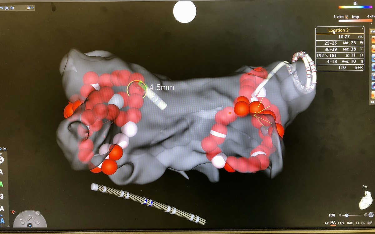 What’s that? You want proof that this first site I ablated demonstrated pure R change from then on?I can go one better.Here’s transition to tag 2: abrupt motion->2nd “stability site” annotation w/o “lost” RF, 4.5mm away (pic 1), with pics2+3 showing immediate+ongoing pure R