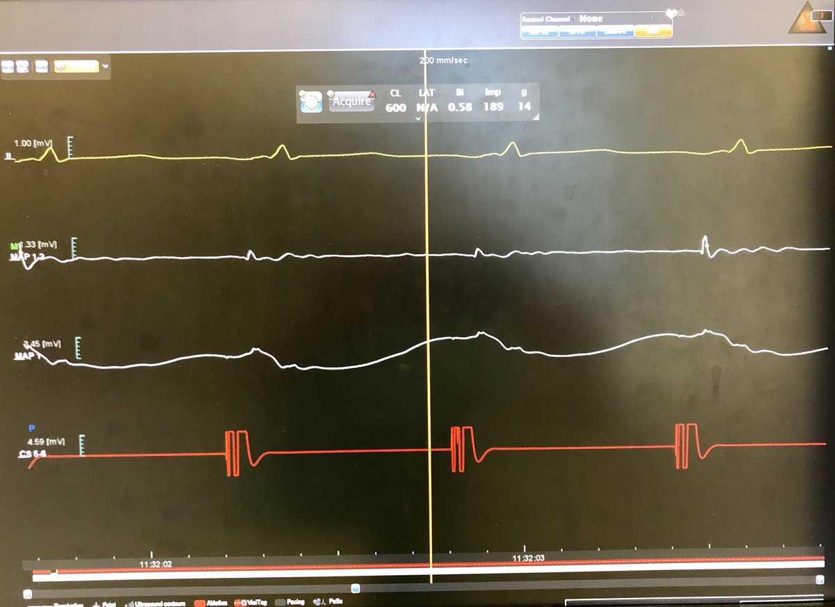 What’s that? You want proof that this first site I ablated demonstrated pure R change from then on?I can go one better.Here’s transition to tag 2: abrupt motion->2nd “stability site” annotation w/o “lost” RF, 4.5mm away (pic 1), with pics2+3 showing immediate+ongoing pure R