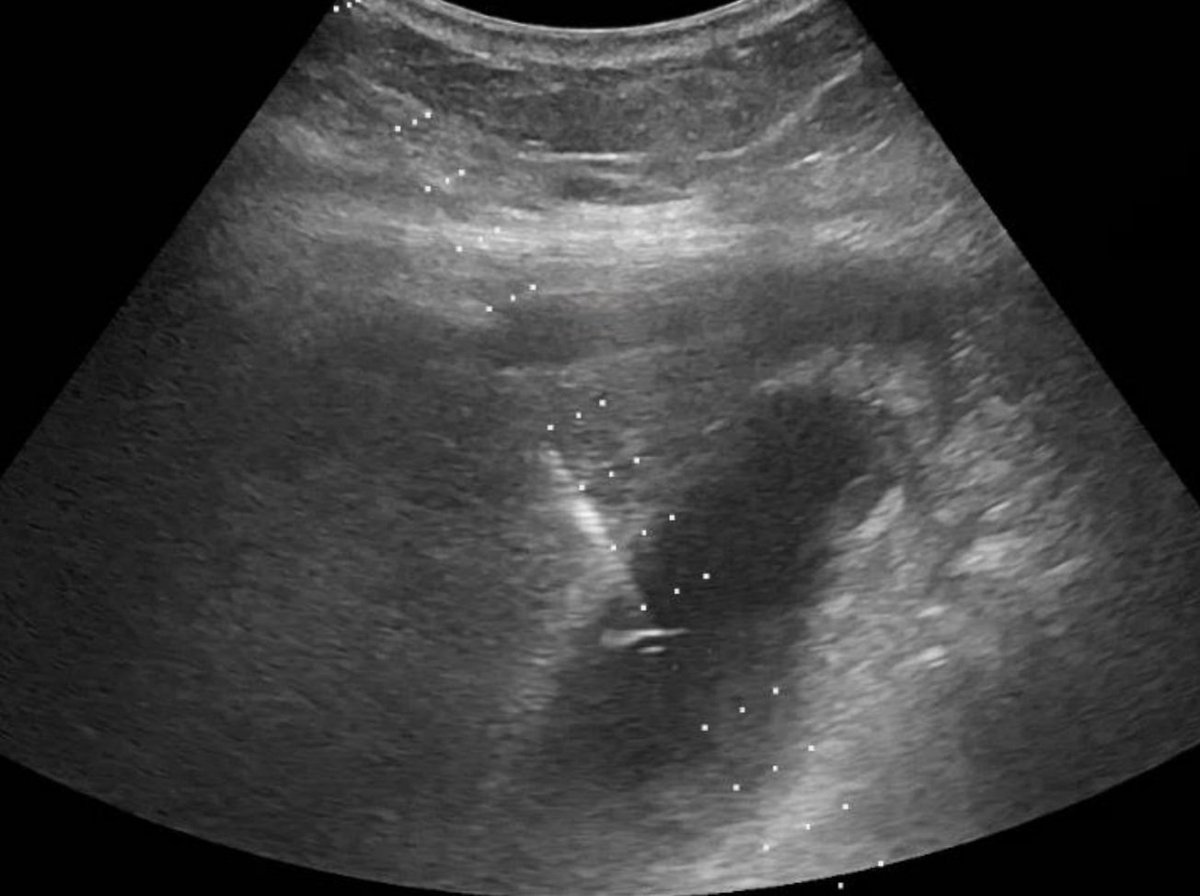 urmed_ir's tweet photo. When your patient is too sick to remove a gallbladder, who ya gonna call? #Irad
#Ultrasound #Interventional #Radiology #InnovationToHeal #TwittIR #BasicIR https://t.co/liEVfmd2kX