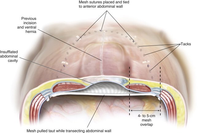 CiruAndes2's tweet photo. Graphical explanation of the mesh overlap in umbilical and ventral hernias! #SoMe4Surgery #MedTwitter @juliomayol @SWexner @almagoch @MISIRG1 @NeilFlochMD https://t.co/flzVF0J6Lc