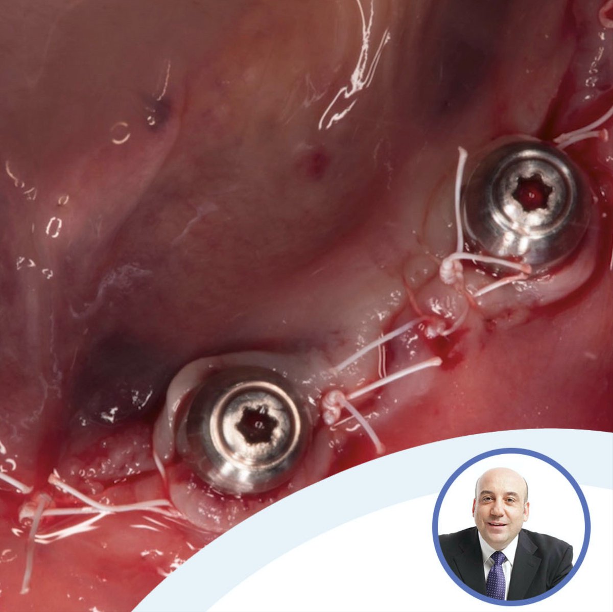 for_org's tweet photo. Do you know how to do a full thickness flap All-on-4® surgery?

Enjoy the video, click here: https://t.co/4wMkgFQUKY 
⁣⁣
#FORdental #oralrehabilitation #oralimplantology #dentalimplants #softtissuemanagement #dentalaesthetics #dentalrestoration https://t.co/XTgp0CdHxi