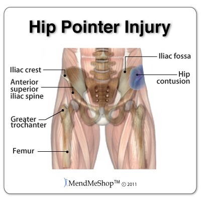 MendMeShop's tweet photo. A hip pointer injury will cause damage and bruising (a contusion) to the iliac crest (hip bone of the #pelvis), surrounding #muscles (i.e. #abdominal, hip abductors &amp; flexors), and the greater #trochanter at the top of the #femur. https://t.co/M3MUgm25eP #mendmeshop https://t.co/WFqGicbjzh