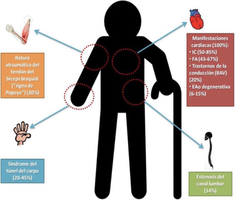 sergi_yun's tweet photo. #ATTR What we now see is just the tip of the iceberg. Fenotipemos a nuestros pacientes con #heartfailure para poder ofrecer un tratamiento personalizado, preciso y dirigido a todos nuestros pacientes. https://t.co/NnBnkItSW7 https://t.co/3ut0eH5cGE