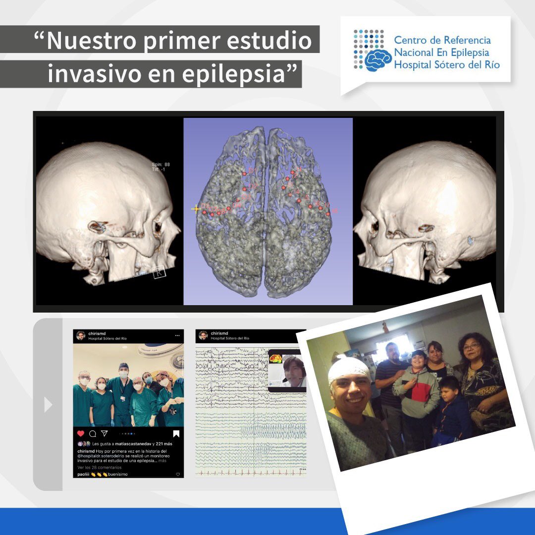 De alta nuestro primer paciente estudiado con electrodos invasivos en <a href="/SoterodelRio/">Sótero del Río</a> Está tan feliz de NO TENER CRISIS que nos autorizó a publicar su foto. Un gran equipo el Centro de Referencia Nacional en Epilepsia. Gracias a todos 👏🏻👏🏻👏🏻 <a href="/DrCantillano/">Dr Christian Cantillano M.</a> <a href="/neuropuc/">Patricio Sandoval</a> <a href="/Jaigodoy/">Jaime Godoy F</a>