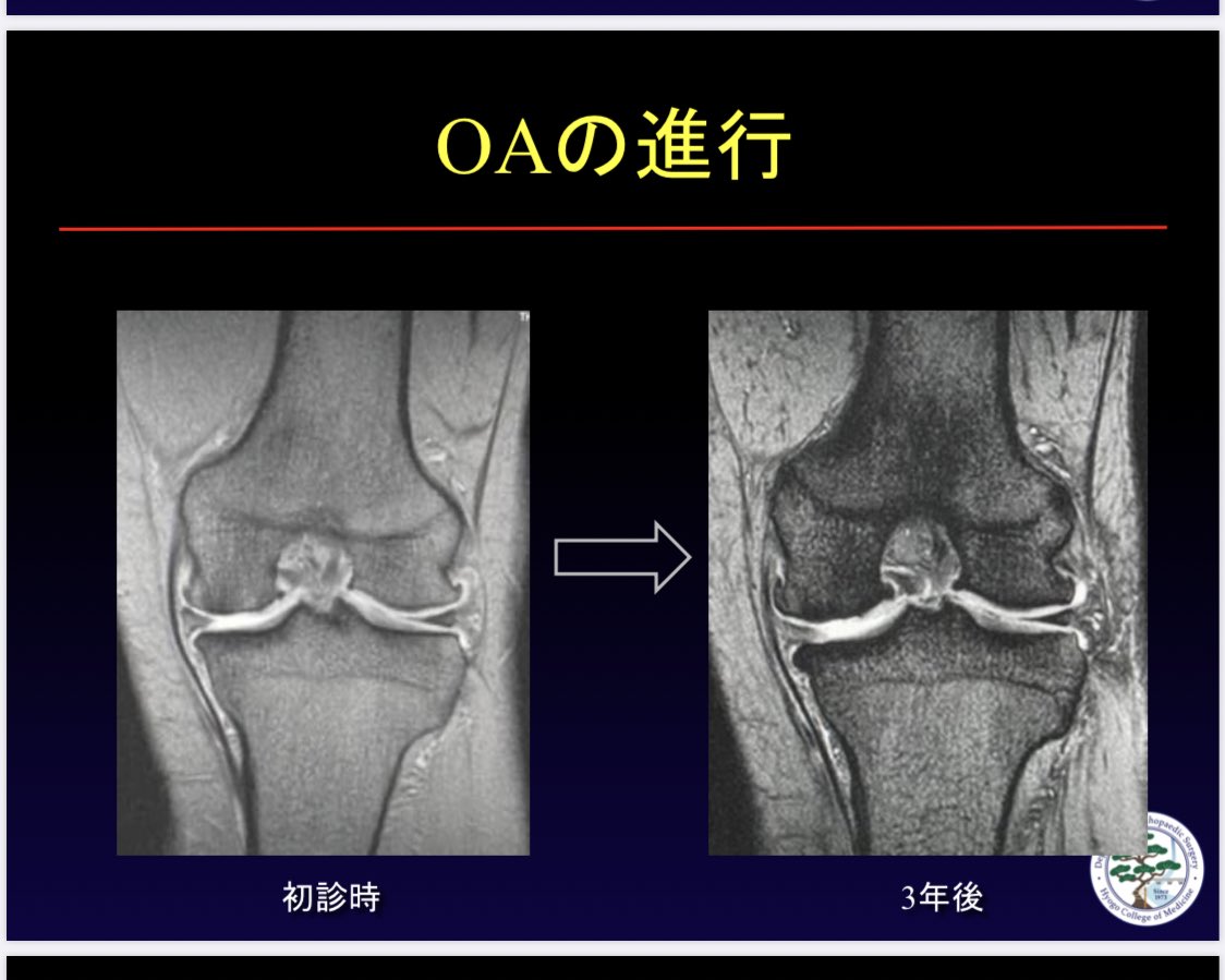 中山 寛(Hiroshi Nakayama) в X: „変形性膝関節症の進行 (MRI 中山 寛(Hiroshi Nakayama) в X: „変形性膝関節症の進行 (MRI