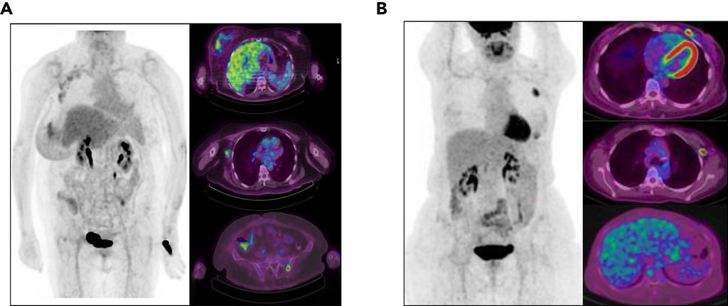 JNCCN's tweet image. Clinical Utility of 18F-FDG PET/CT in Staging Localized #BreastCancer Before Initiating Preoperative Systemic Therapy: buff.ly/3i4q5Lk #BCSM #radonc @CancerDocKo @CharitoLoveMD1 @jsparano