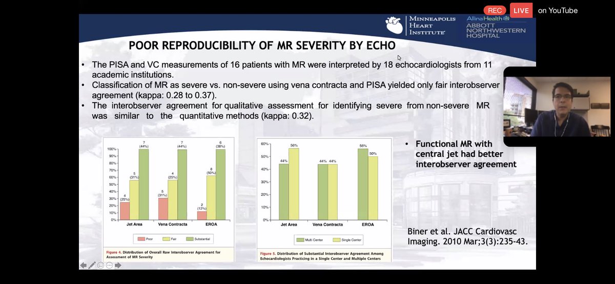 2/Limitations of  #echofirst:overestimation of MR by PISA, underestimation of eccentric MR. poor reproducibility if MR severity (inter- and intra-observer)Alas, there is no accuracy without reproducibility 