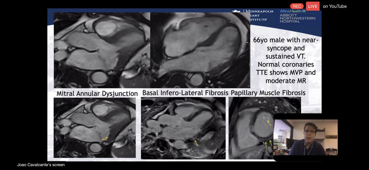 5/ #WhyCMR for arrhythmogenic MVP phenotype: prevalence of MF in MVP vs non MVP & greater w/ LV remodeling & MR severity.”interstitial  disease” described >40 yrs ago in  s w/ chronic vol/pressure overload. #WhyCMR helps identify structural myocardial changes