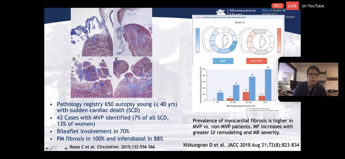 5/ #WhyCMR for arrhythmogenic MVP phenotype: prevalence of MF in MVP vs non MVP & greater w/ LV remodeling & MR severity.”interstitial  disease” described >40 yrs ago in  s w/ chronic vol/pressure overload. #WhyCMR helps identify structural myocardial changes