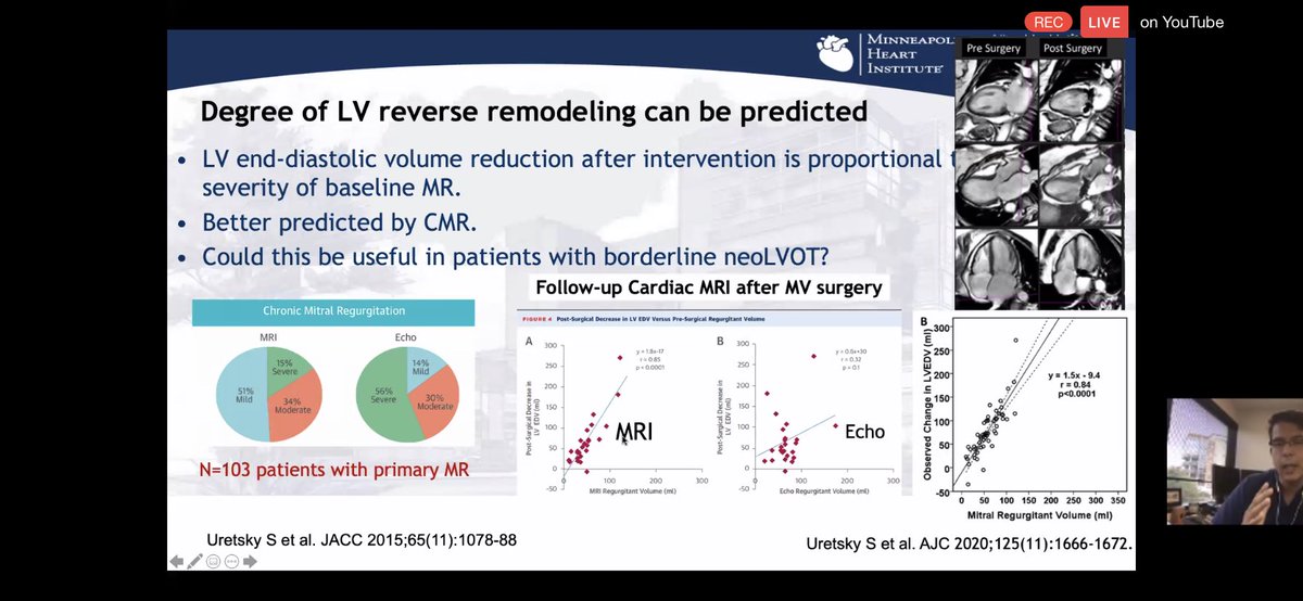 3/  #WhyCMR for Primary MRCIRC ‘17CMR severe-TTE moderate MR outcomes similar to CMR severe-TTE-severe MR.JACC ‘15correlation of MR estimates by  #WhyCMR &  #echofirst in pts referred to MV Sx. correlation b/w post-op LV remodeling & baseline MR severity by CMR