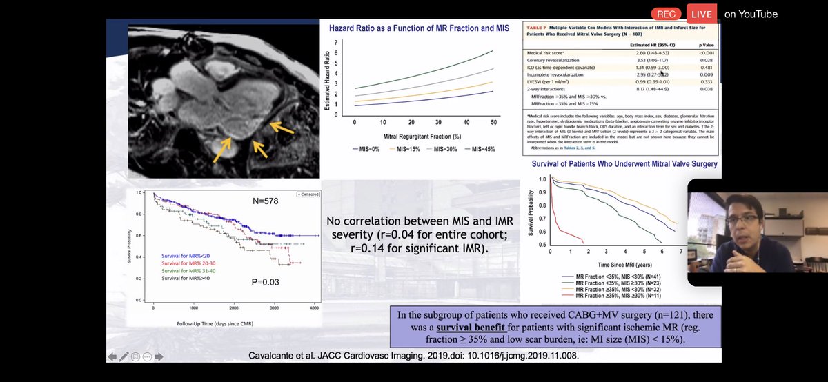 7/JACC 2019patients with ICM+ FMR,MIS quantified by LGE. on multivariable analysis, interaction of MIS & IMR was a  predictor of adverse outcomes. subgrp analysis: pts w/ subsequent CABG+MVR had better outcomes if significant FMR but  MIS at baseline.