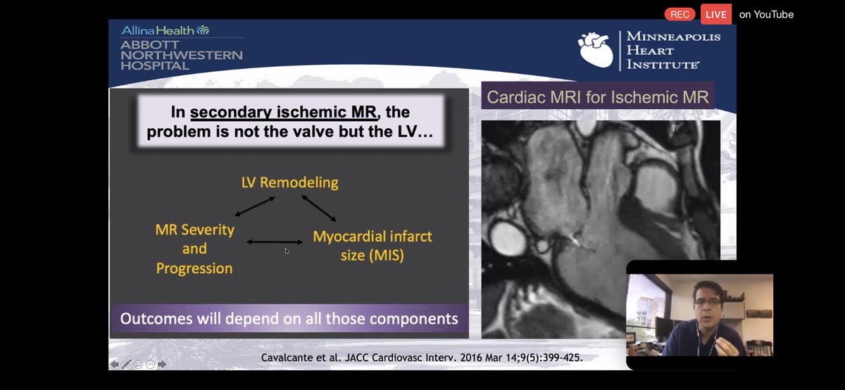 6/ #WhyCMR in FMR:ongoing attempts at quantifying & characterizing significant FMR to help triage patients for appropriate therapies.FMR is a dz of the LV. Need better assessment of LV “health” and  #echofirst with abundant limitations in this regard. Enter  #WhyCMR