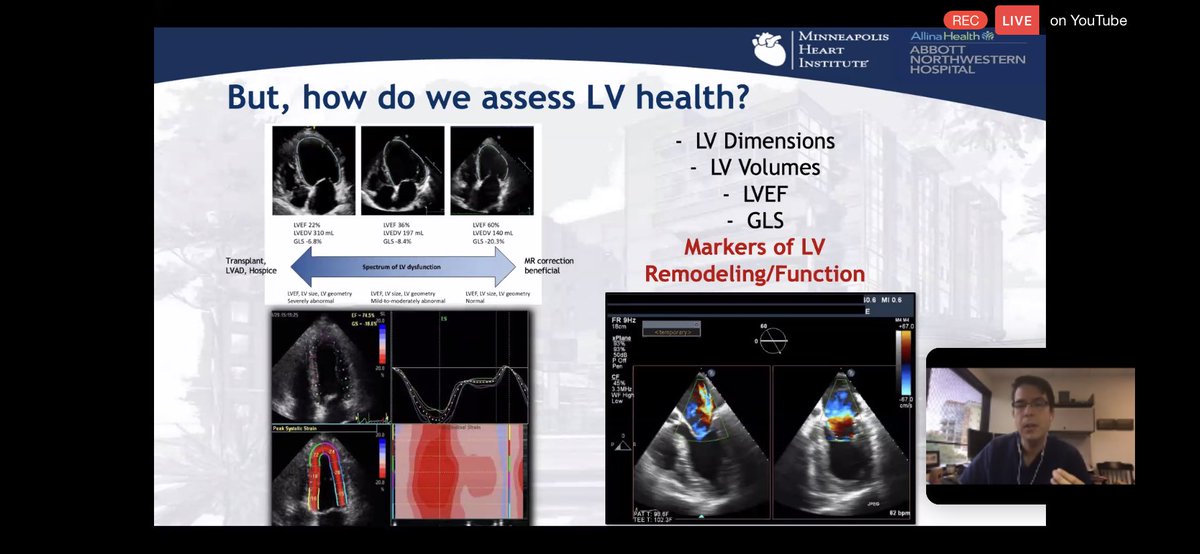 6/ #WhyCMR in FMR:ongoing attempts at quantifying & characterizing significant FMR to help triage patients for appropriate therapies.FMR is a dz of the LV. Need better assessment of LV “health” and  #echofirst with abundant limitations in this regard. Enter  #WhyCMR