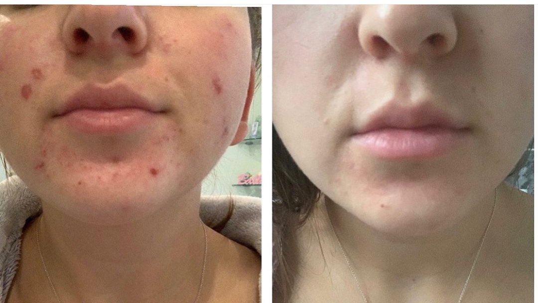 by_charl's tweet photo. Before and After first client #Skin #skincare #investinyourskin #beauty 
#chemicalpeel https://t.co/nXrfzI6mUi