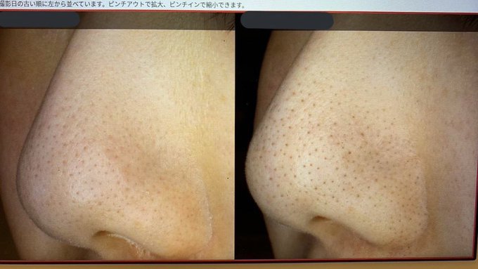 いちご鼻が悪化してしまった原因を考える 目指せ毛穴レス いちご鼻と戦うちゃんの奮闘ブログ