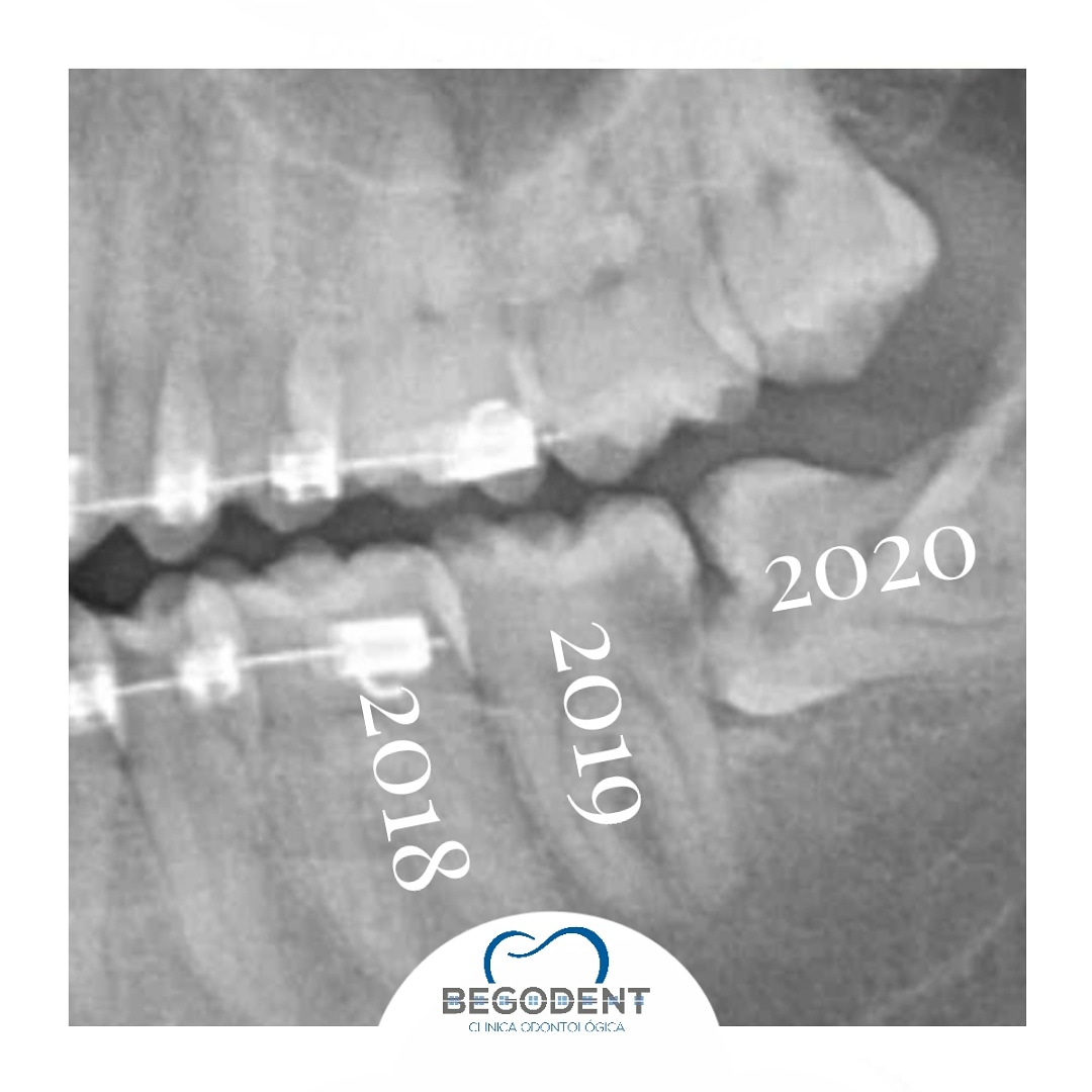 RodolfoBerrueto's tweet photo. Si los años fueran muelas el 2020 sería la del juicio...
Humor dental 🤣😅
.
.
.
#covid #muelasdeljuicio #piedrasnegras #begodent #meme #smile #happy https://t.co/COPaRkXwKa